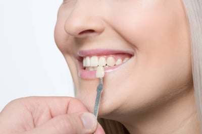 5 Reasons To Look Into Getting Porcelain Veneers